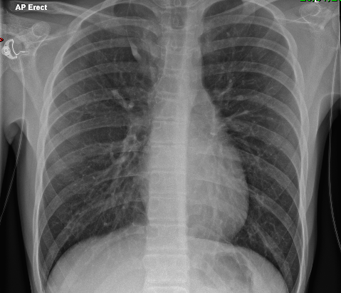 Azygos love on chest x-ray